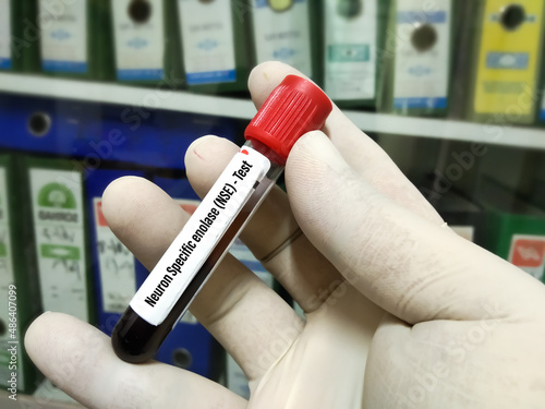 Blood sample for Neuron-specific Enolase or NSE Blood Test. To diagnosis and ongoing monitoring of patients with small cell lung carcinoma photo
