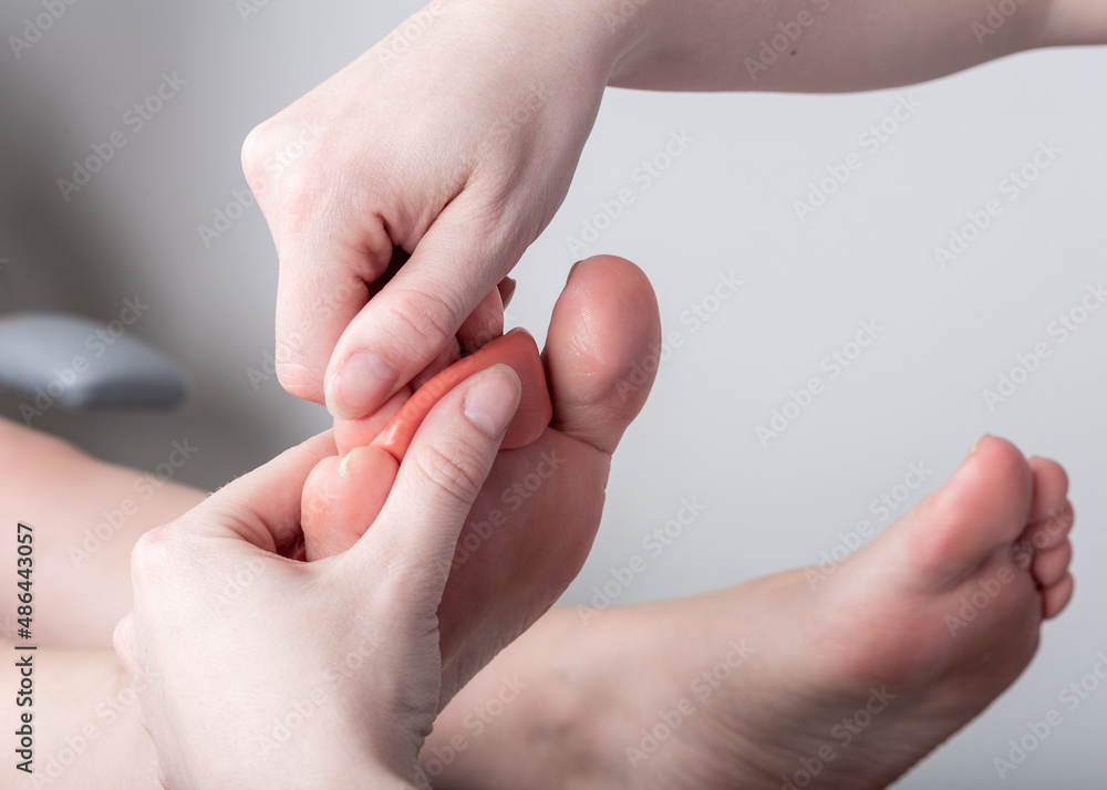 A podiatrist applies a paste to a patient's foot. A podiatrist applies a paste to a patient's foot.
