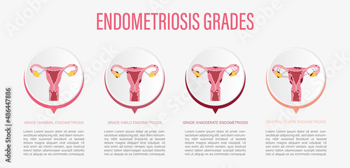 Vector illustration of degrees of endometriosis.