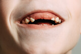 Photo of a child's mouth missing his two front teeth New teeth can't grow for a long time New teeth do not grow smoothly