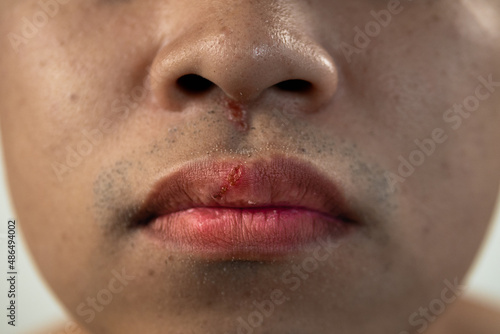 Cracked lips of man in winter season. Close up shot. This man skin is asian style. photo