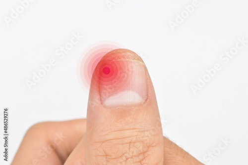 Inflammation at the tip of fingernail. Concept of paronychia at thumb of Asian man. Painful finger. photo