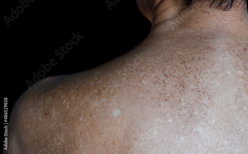 Photography Age spots and white patches on upper back