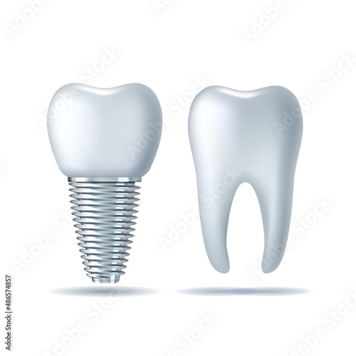 Vector 3d realistic white Tooth and dental Implant. Denture icon closeup isolated on white