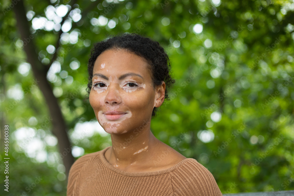 girl with vitiligo on her face looking at the camera
girl with vitiligo on her face looking at the camera