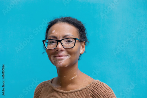 beautiful girl with vitiligo on her face
 photo