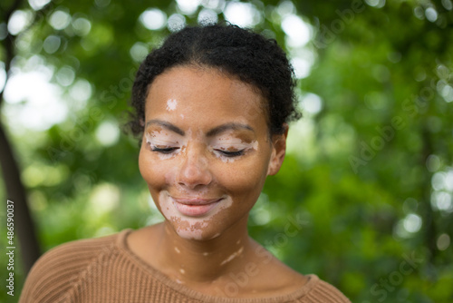 close-up portrait of a girl with vitiligo
 photo