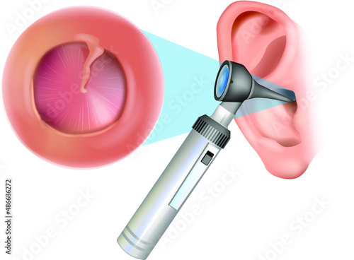 Ear examination with an otoscope. Otitis media with effusion: serous otitis media, secretory otitis media. Redness and inflammation of the eardrum. Otorhinolaryngology