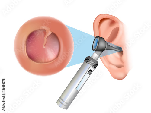 Ear examination with an otoscope. Otitis media with effusion: serous otitis media, secretory otitis media. Iinflammation of the eardrum. Otorhinolaryngology photo