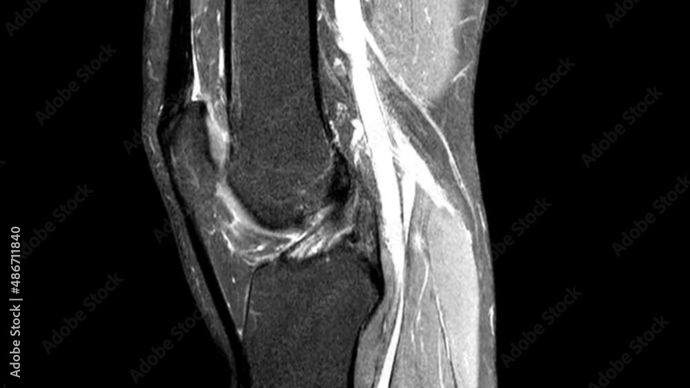 MRI knee joint. Magnetic resonance imaging of right knee. Diagnosis ...