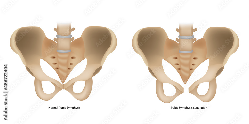 Pubic Symphysis Separation or SPD. Symphysis Pubis Dysfunction and Normal  Pupic Symphysis. Stock Illustration