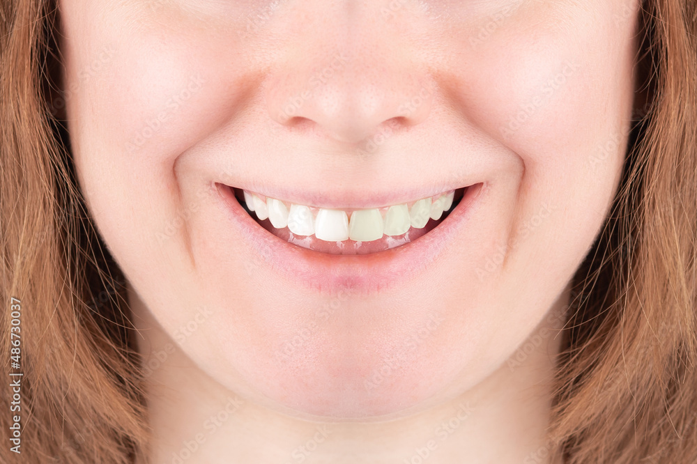 teeth whitening before after,yellow dirty and white clean tooth,stomatological cleaning teeth whitening before after,yellow dirty and white clean tooth,stomatological cleaning