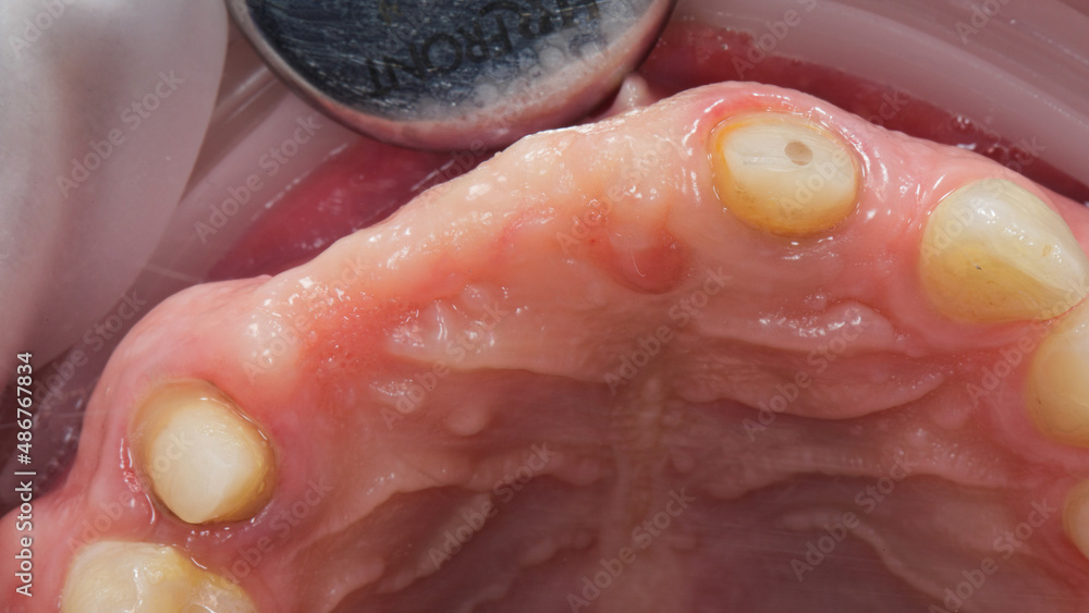 gum without teeth before dental implantation, view through the mirror gum without teeth before dental implantation, view through the mirror
