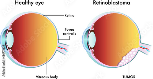 Medical illustration compares a healthy eye with one affected by retinoblastoma.