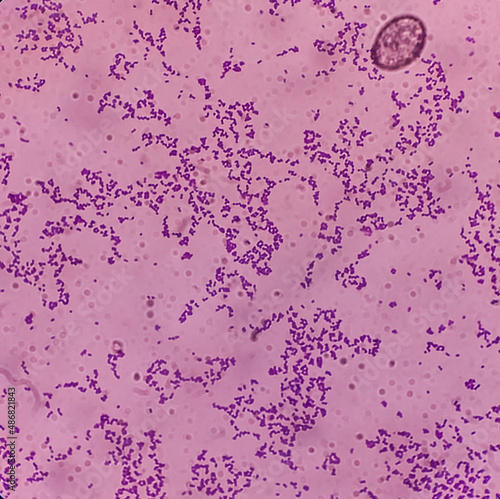 Microscopic view of Enterococcus bacteria from UTI patient urine sample, show gram-positive cocci at gram's staining slide. focus view photo