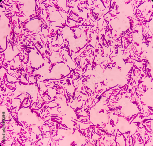 Salmonellosis: microscopic view of gram stained slide from blood agar salmonella colonies, show Salmonella Typhi (S. Typhi) bacteria, disease is referred to as typhoid fever.