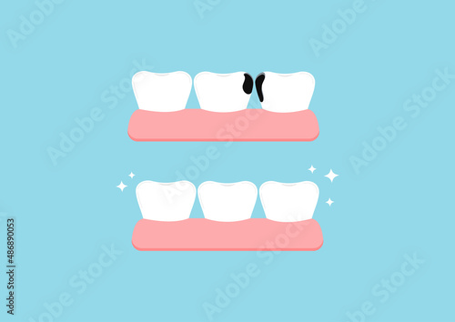 Teeth before and after proximal decay in gym dental icon set isolated on blue background. Both tooth with interdental caries hole treatment concept. Flat cartoon dentistry clip art vector illustration
