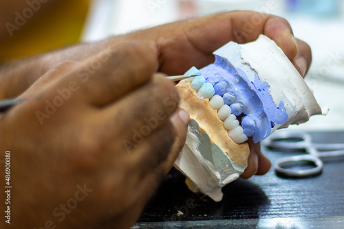denture making