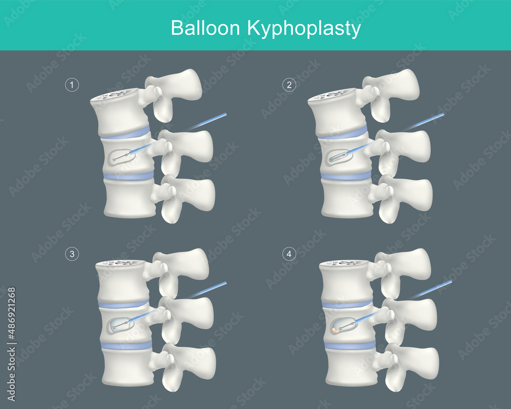 Vetor de Balloon Kyphoplasty. Medical steps for correcting compression fractures and restoring