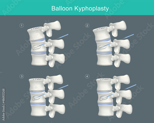 Balloon Kyphoplasty. Medical steps for correcting compression fractures and restoring vertebral body height. Illustration..