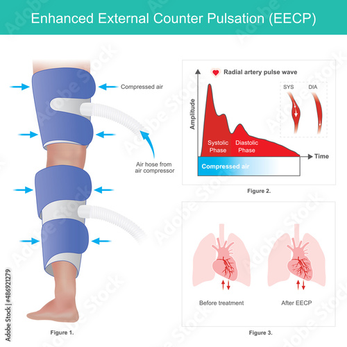 Enhanced External Counter Pulsation. A method of improving blood flow to the heart by use strip constrict around on legs..