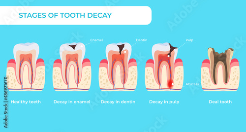 Stage tooth decay infographic medical educational scheme names diagnosis vector flat illustration