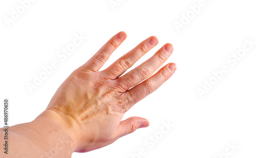 skin irritation on left wrist dermatitis