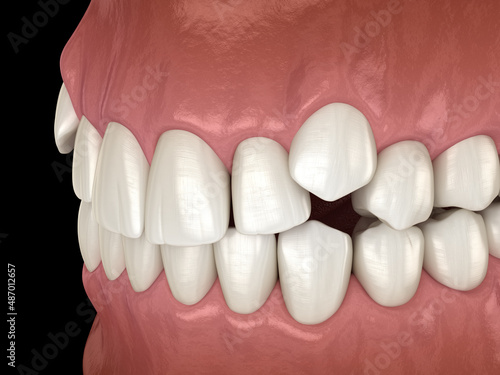 Impacted incisors, overcrowded teeth. Medically accurate 3D illustration of abnormal dental occlusion photo