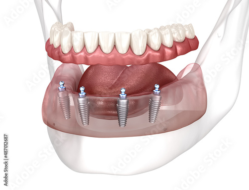 Removable mandibular prosthesis All on 4 system supported by implants. Medically accurate 3D illustration of human teeth and dentures concept photo