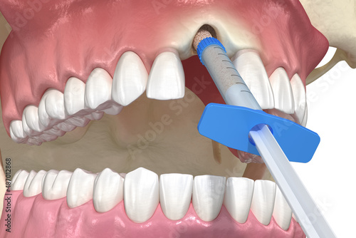 Bone grafting augmentation, socket preservation, tooth implantation. Medically accurate 3D illustration. photo