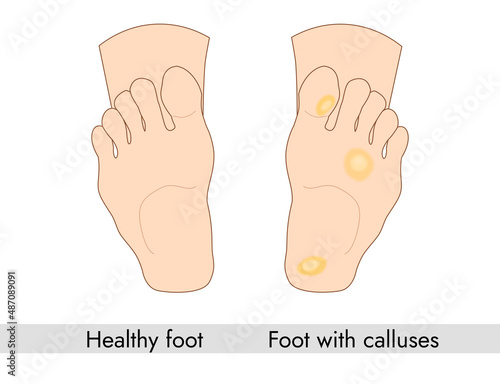 medicine poster of healthy foot and foot with callus
