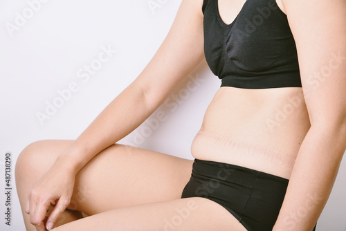 Obraz na płótnie Fat woman sitting and showing belly fat, Overweight obesity woman, Woman muffin top waistline. w salonie