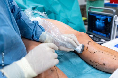 Process of varicose vein surgery in hospital, operating room, vein sealing, venous vascular surgery concept photo