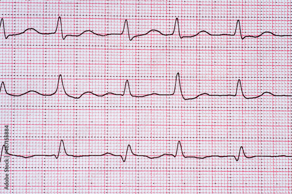 Close Up Echocardiograph test report (ECG) showing abnormal heart rhythm. Close Up Echocardiograph test report (ECG) showing abnormal heart rhythm.