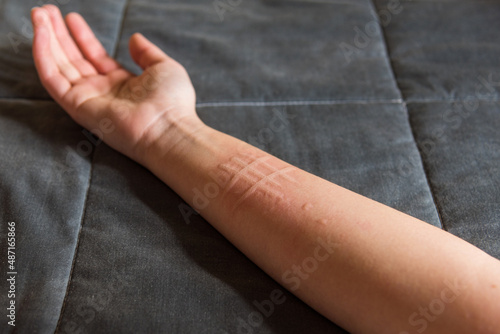 Detalle del brazo de una mujer que padece una afección de la piel llamada dermografismo, dermatografismo o 