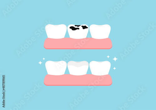 Teeth before and after multiple caries in gym dental icon set isolated. Teeth dentistry restoration with porcelain sealant in cavity treatment concept. Flat cartoon clip art vector illustration.