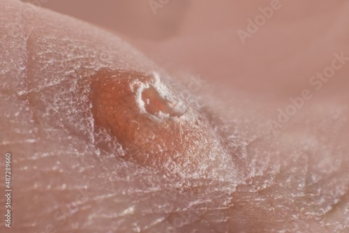 Macrophotography of wart on the human body photo