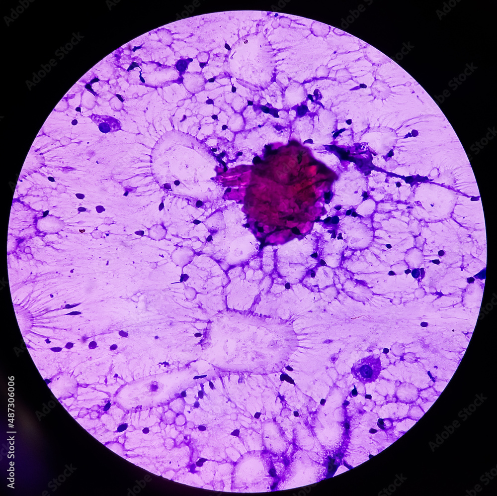 breast-lump-biopsy-fat-necrosis-injury-of-fatty-tissue-show