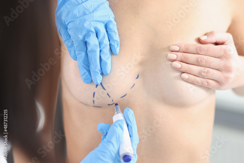 Hands draw with a marker on the female breast, close-up