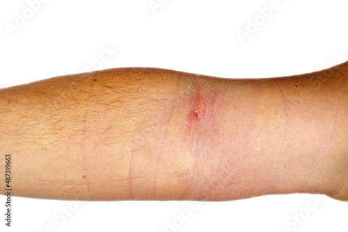 Phlebitis on hand isolated on a white