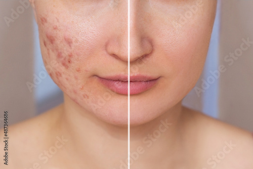 Cropped shot of a young woman's face before and after acne treatment on the face. Pimples, red scars on the cheeks of the girl. Problem skin, care and beauty concept. Dermatology, cosmetology