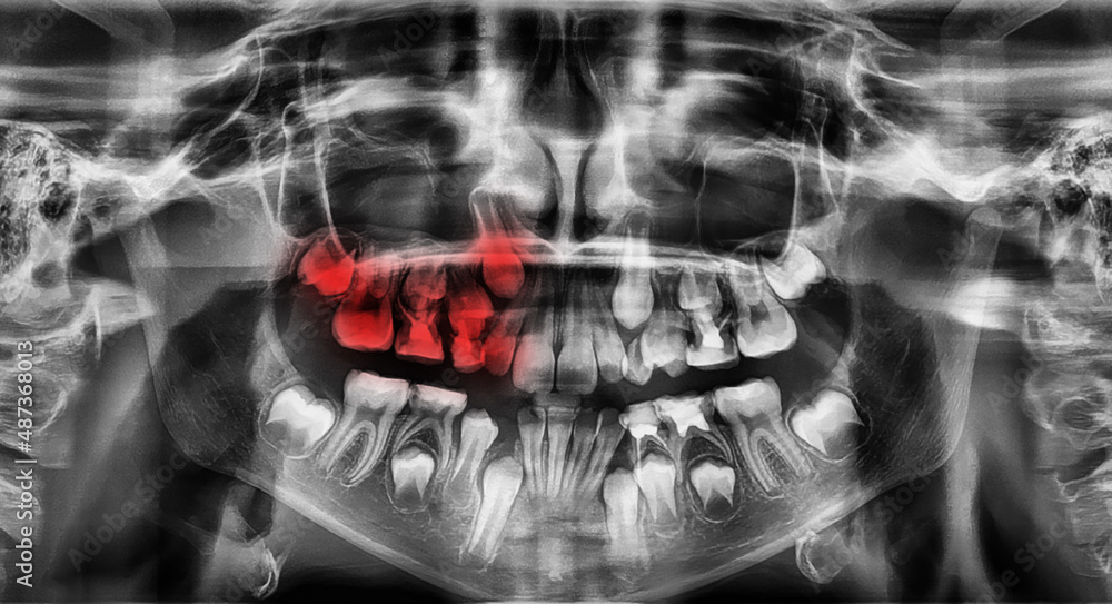 Panoramic x-ray image of teeth Panoramic x-ray image of teeth