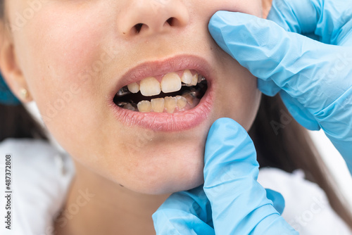 Cropped view of the little girl having her plates checked. Close-up portrait of smiling teenage girl with teeth plates against dentist sitting in clinic. Girl with plates being examined by dentist