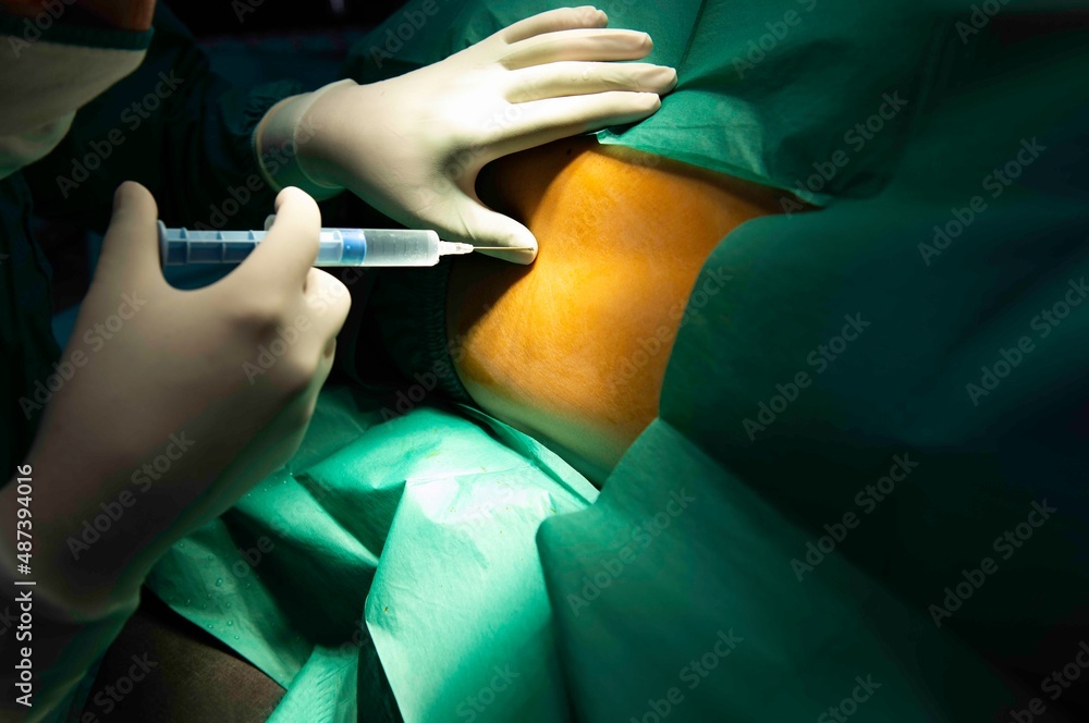 Spinal nerve block. Epidural anesthesia to pregnant woman preparation for pain relief of active