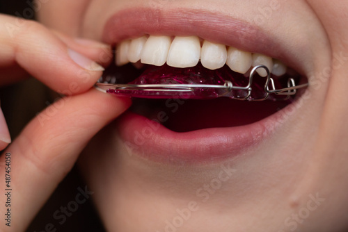 A young woman is putting on her Hawley retainer. 