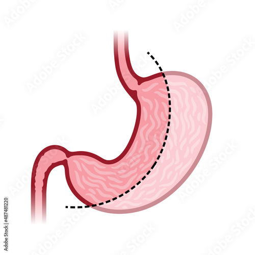 Laparoscopic sleeve gastrectomy
