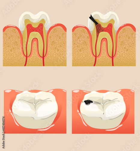 set of Teeth with cavities vector illustraion