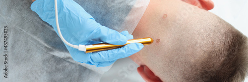 Doctor dermatologist laser cauterization of wart on man neck