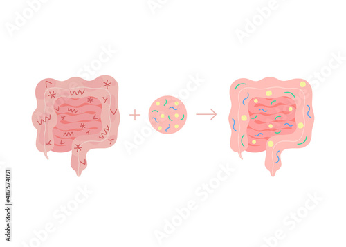 Fecal microbiota transplant from healthy in unhealthy intestine, FMT. Improvement intestinal microflora and normalization stool by introducing beneficial bacteria in bowel colon tract. Vector photo