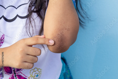 Finger of girl point to her elbow because dark patches on the skin and allergic rash known as acanthosis nigricans look like a darkened velvet.